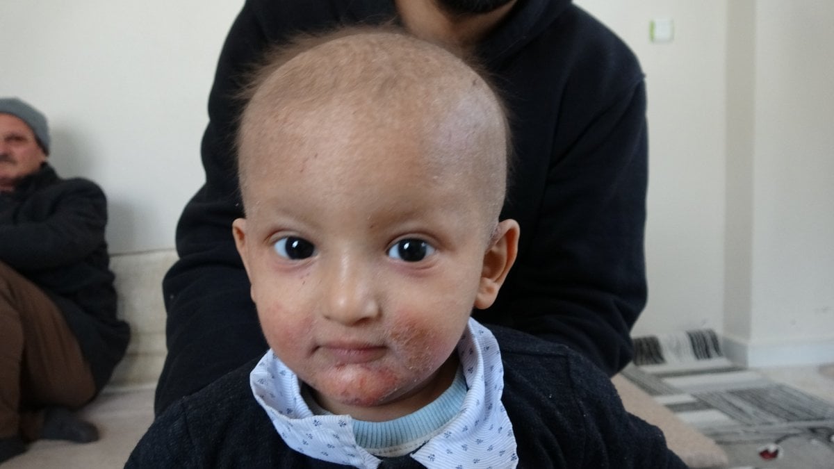Mardin de küçük çocuk, nadir görülen balık pulu hastalığıyla yaşıyor #4