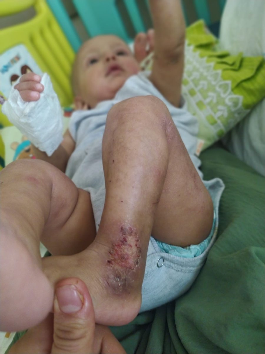 Mardin de küçük çocuk, nadir görülen balık pulu hastalığıyla yaşıyor #5
